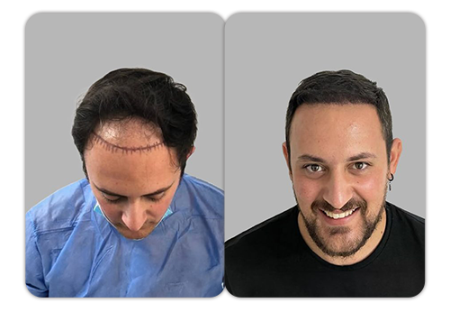 Patient result 4 — before and after hair restoration